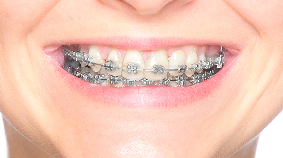 Traditional Orthodontics